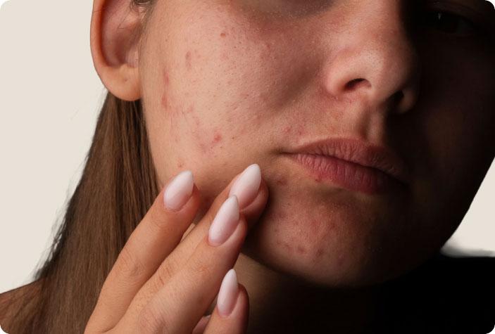 Why Am I Getting Acne?