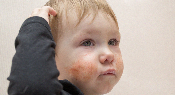 Dermatologi Pediatri