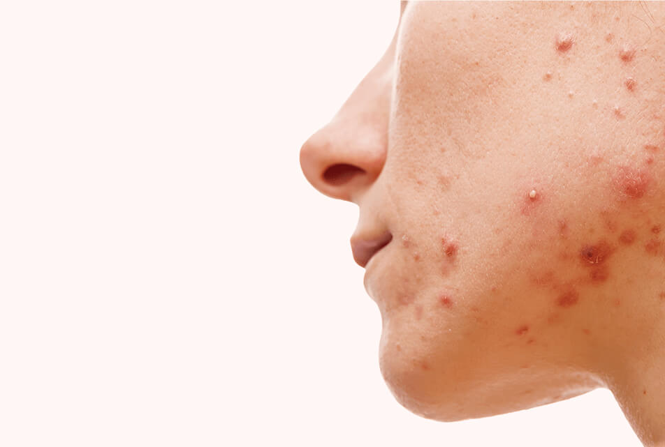acne on face, acne, acne removal, girl with acne