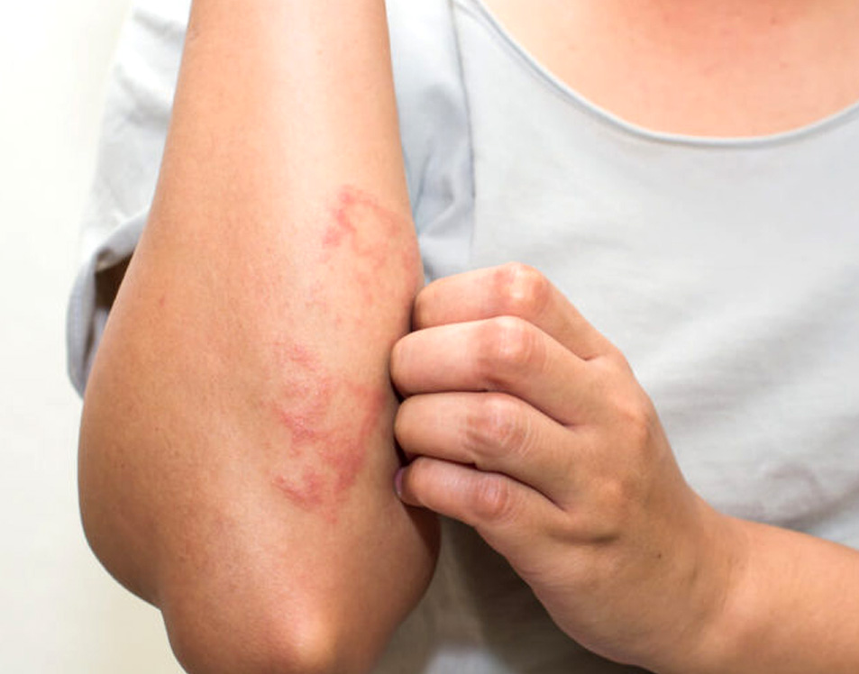 eczema flare-ups, treatment for eczema