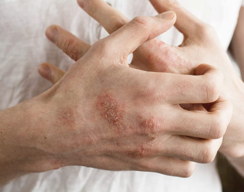 eczema flare-ups on hands, itching hands, eczema treatment