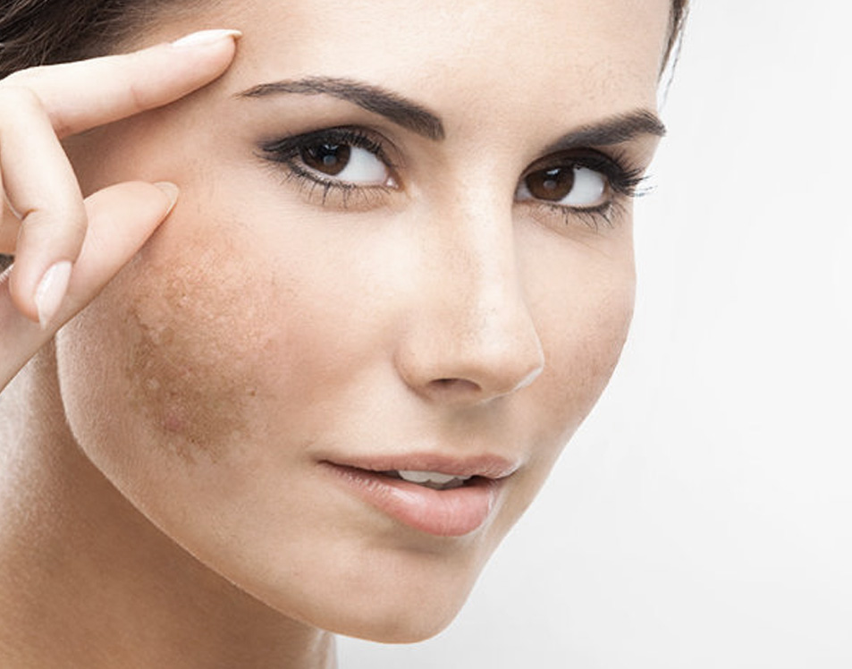 Treatment for Skin Pigmentation