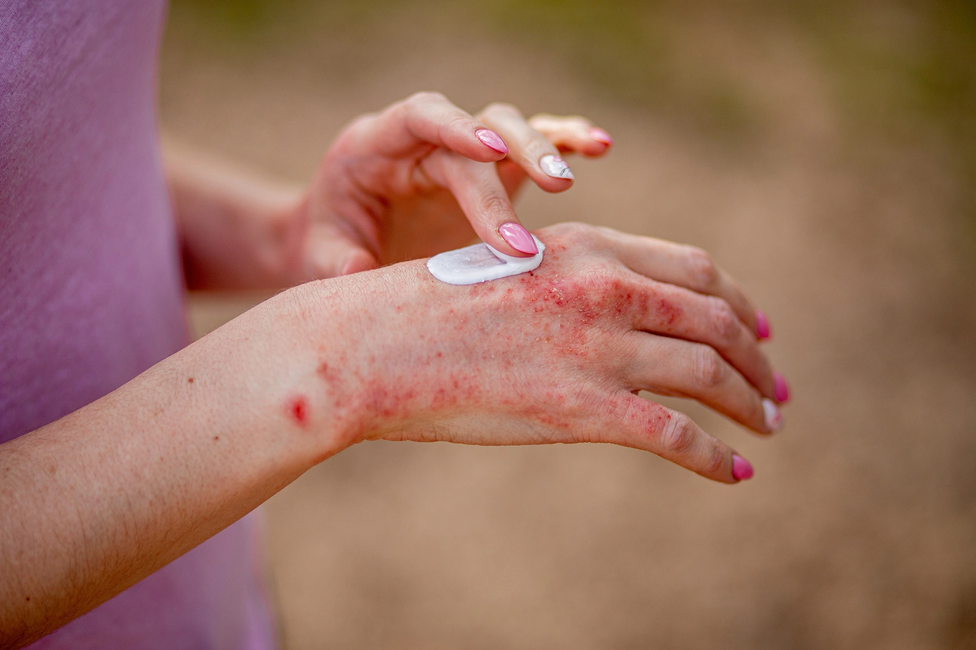 A Patient’s Guide to Psoriasis Care in Singapore