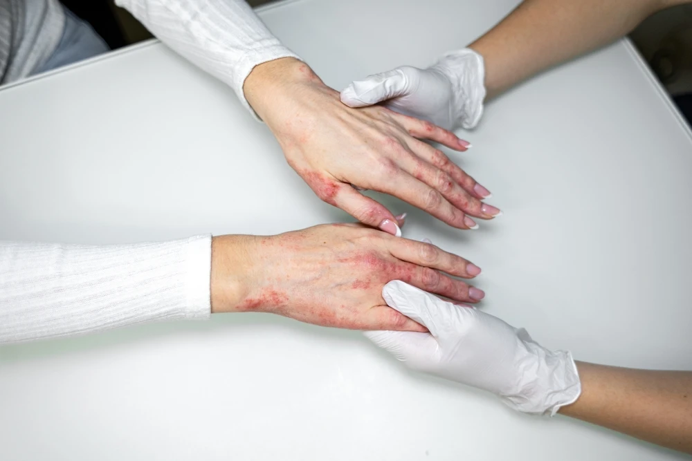 Dermatologist examining the hands of a patient with adult-onset eczema.