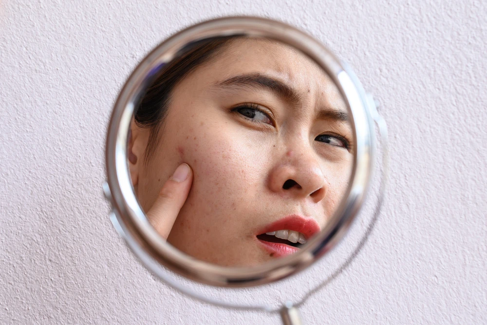 Woman examining her acne scars in a mirror