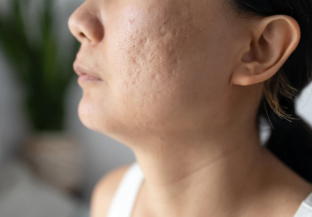 Woman with multiple types of atrophic acne scars