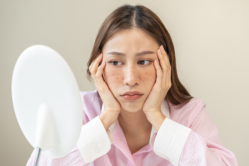 How Does a Dermatologist Remove Acne and Acne Scars?