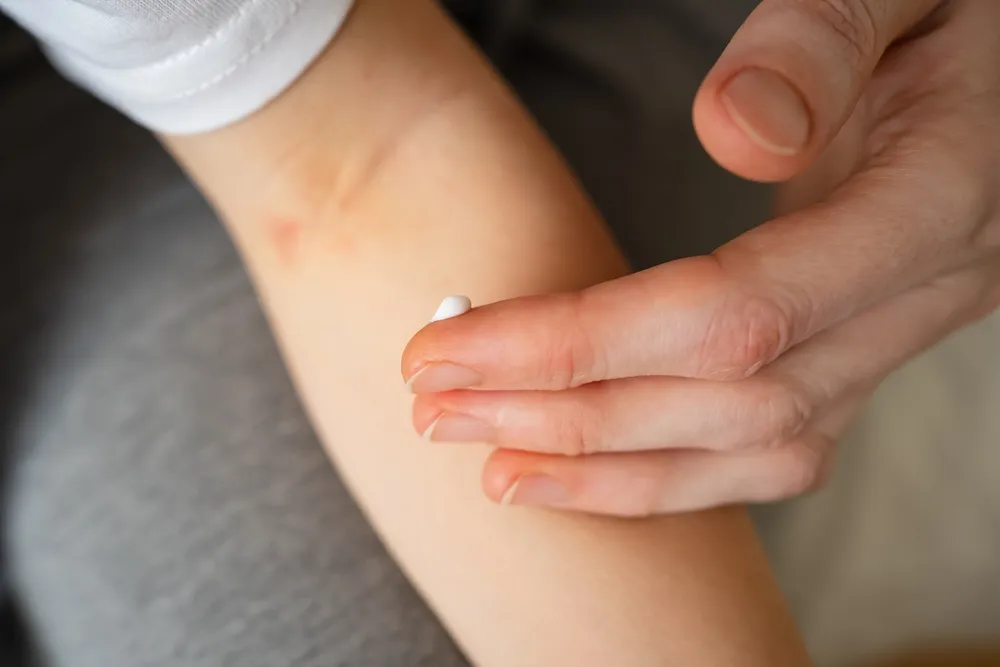 Person applying a small amount of topical cream to irritated skin