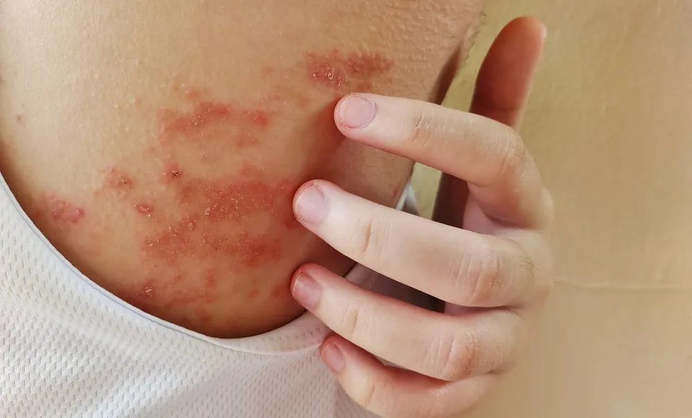 Person scratching a rash caused by eczema
