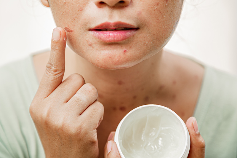 Acne Treatment: Long-Term Solutions for Handling Breakouts