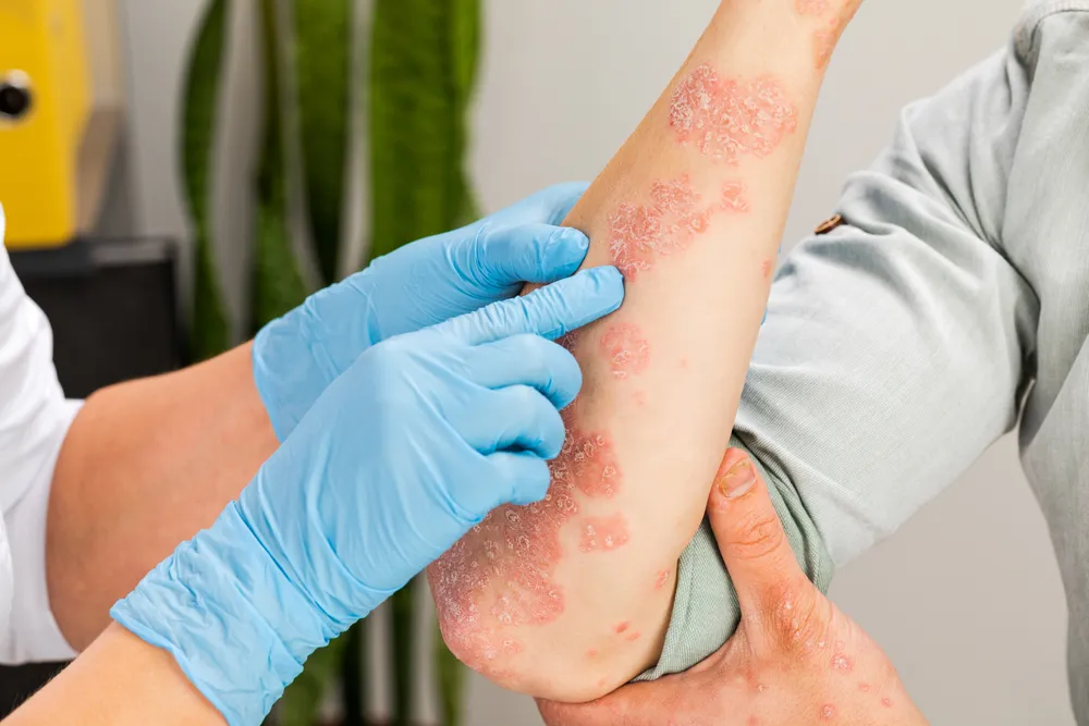 Dermatologist examining psoriasis on a patient’s arm 
