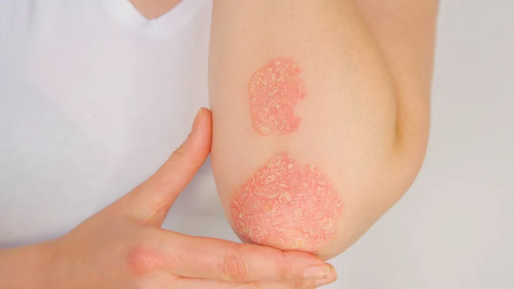 Psoriasis plaques on a person’s elbow. 