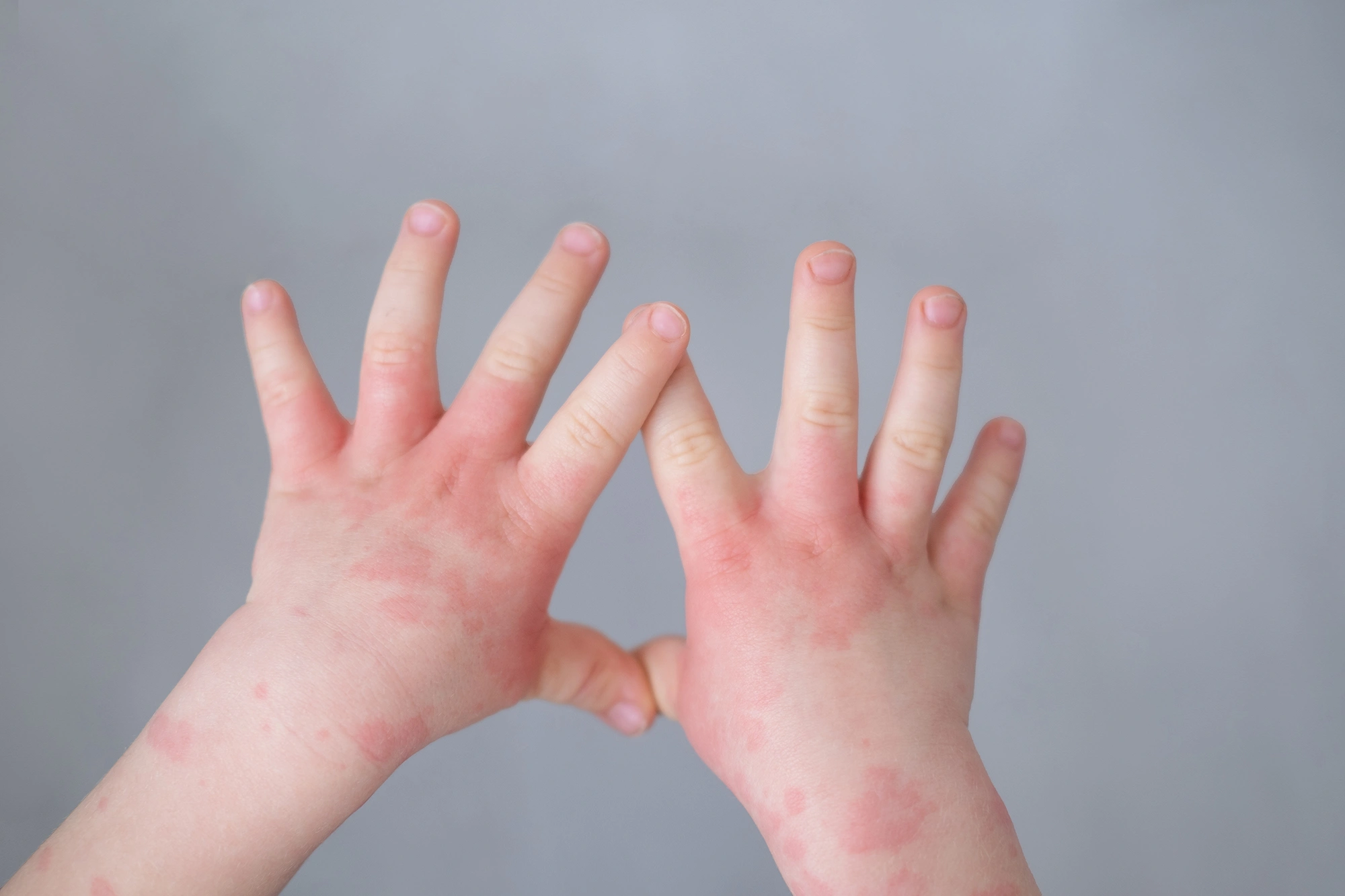 What Parents Should Know About Eczema in Children