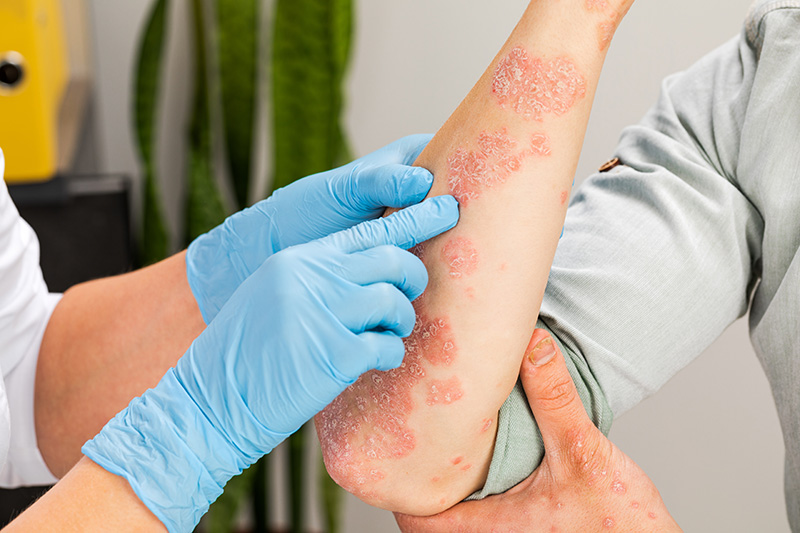 A dermatologist examining a patient's psoriasis breakout