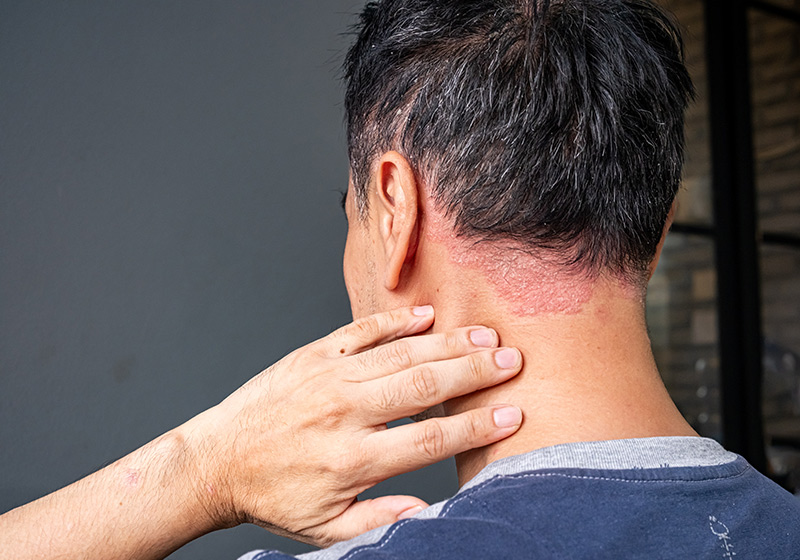Why Psoriasis Severity Fluctuates Even with Ongoing Treatment