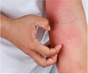 Treating Eczema: Newer Approaches To A Common Problem